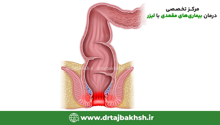 تفاوت بواسیر و سرطان مقعد چیست؟
