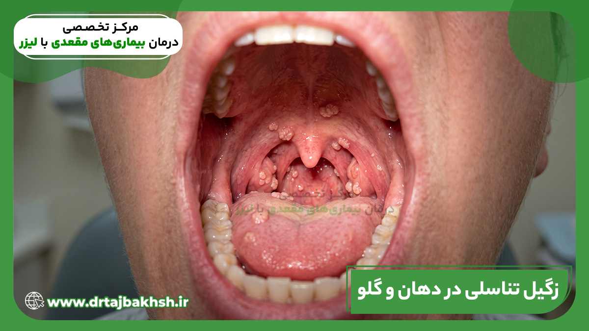 زگیل تناسلی در دهان و گلو چیست؟ علائم، انتقال و درمان