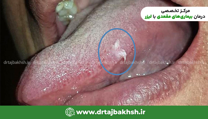 زگیل دهانی چگونه منتقل می شود؟ | عکس زگیل دهانی